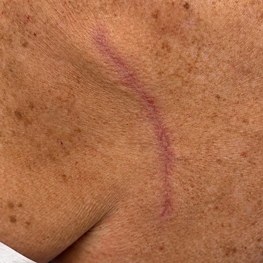 Healed linear scar on the posterior shoulder at follow-up