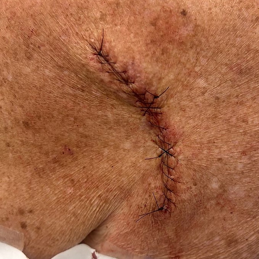Sutured linear closure on the posterior shoulder