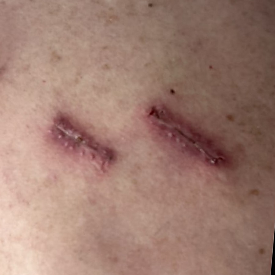 Two healed linear scars on the upper back at follow-up