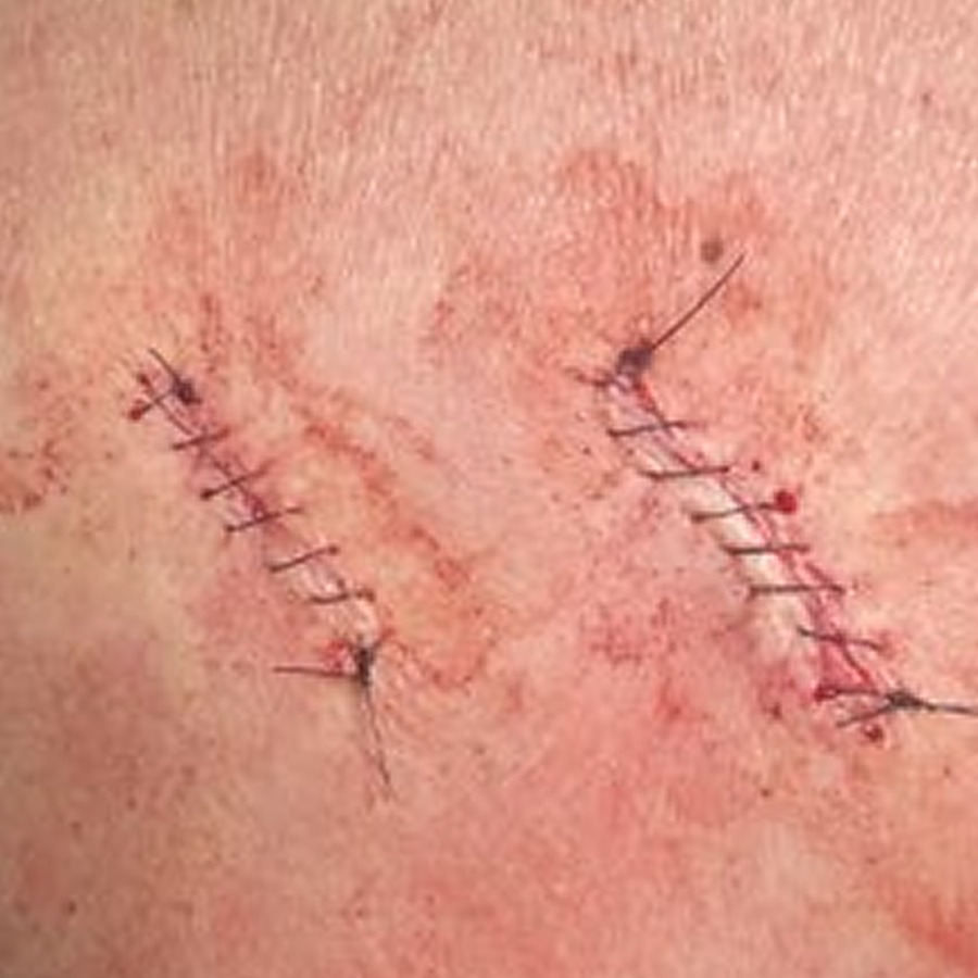 Two sutured linear closures on the upper back