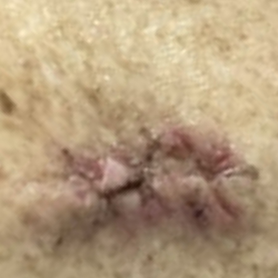 Healed scar on the posterior shoulder at follow-up