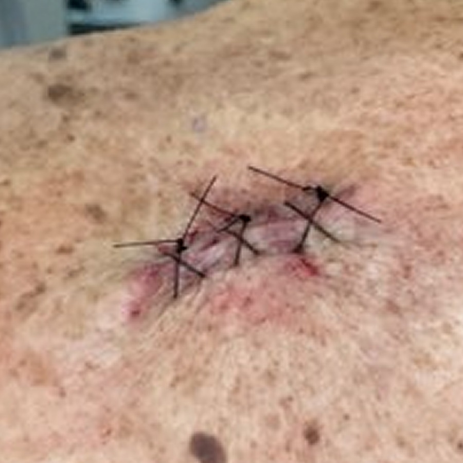Sutured closure on the posterior shoulder
