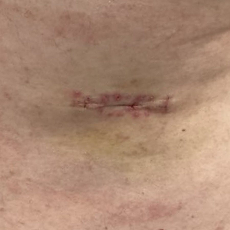 Healed linear scar on the lateral upper back at follow-up