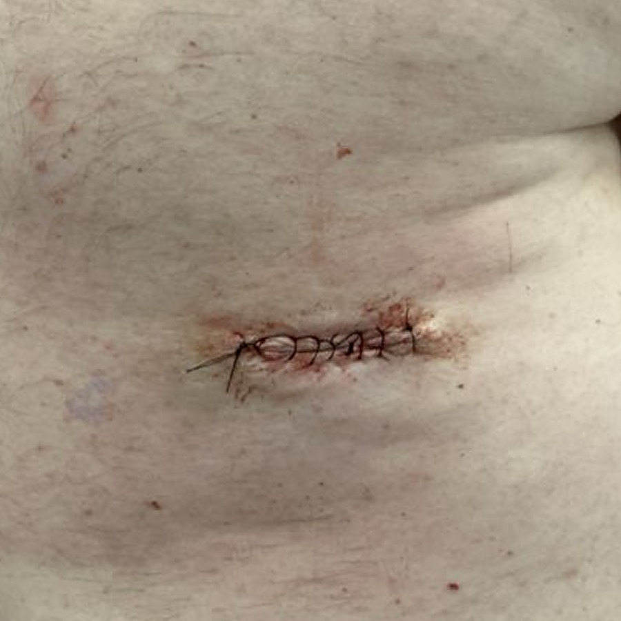 Sutured linear closure on the lateral upper back
