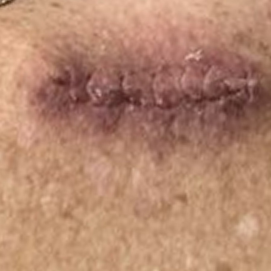 Healed linear scar on the upper back at follow-up
