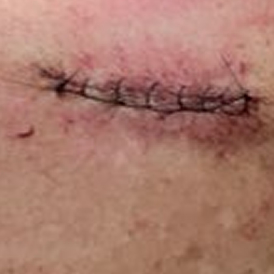 Sutured linear closure on the upper back