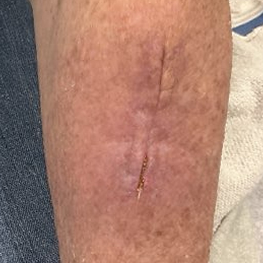 Healed linear scar on the forearm at follow-up