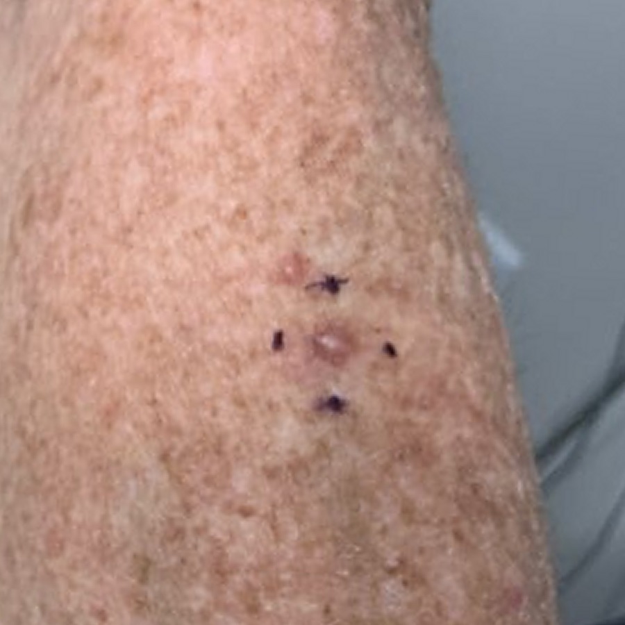Marked keratoacanthoma on the forearm before excision