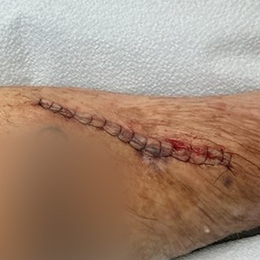 Sutured linear closure on the forearm