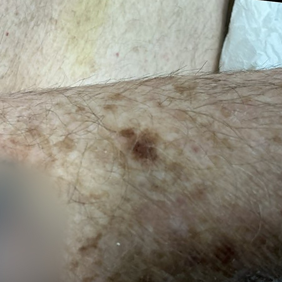 Pigmented lesion on the forearm before excision