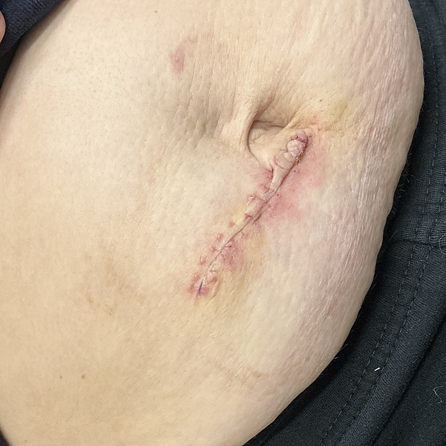 Healed periumbilical linear scar at follow-up