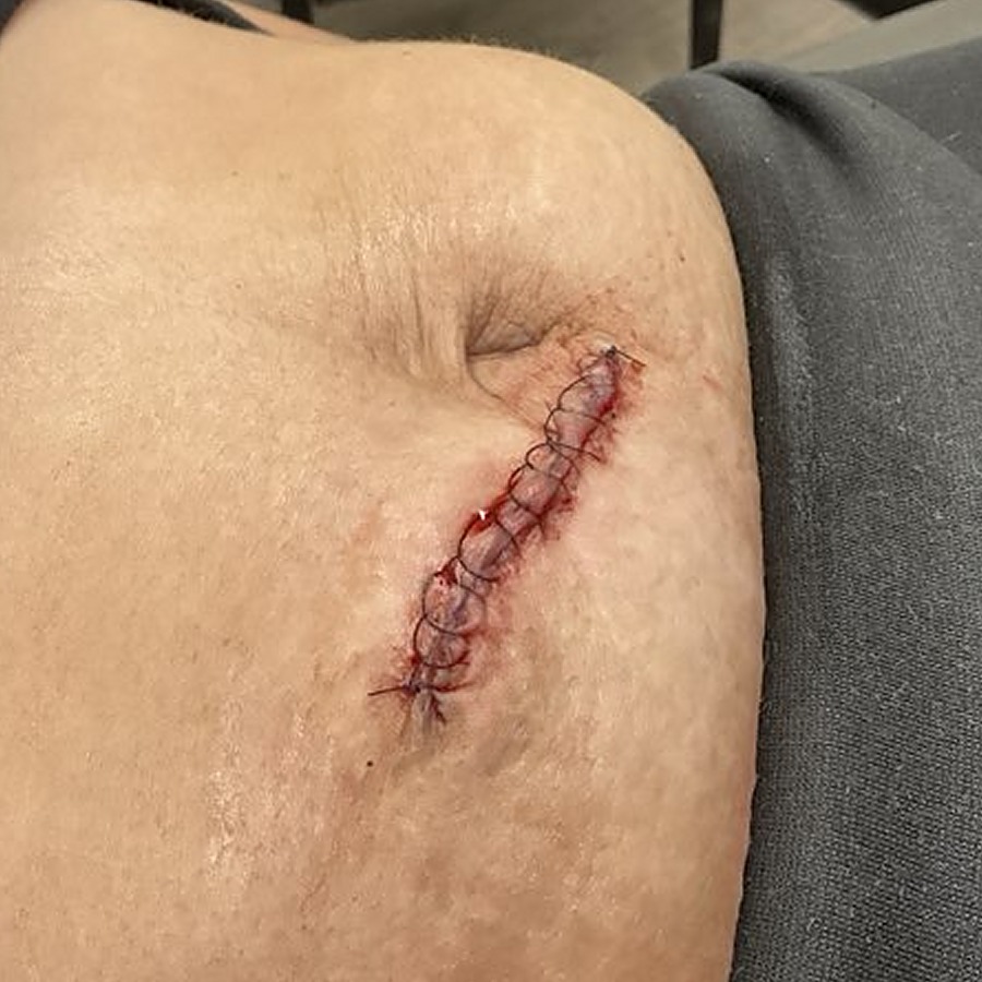 Sutured periumbilical closure
