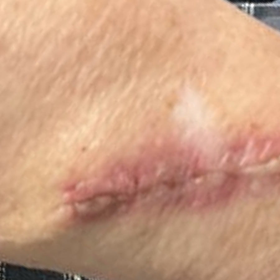 Healed linear scar on the posterior upper arm at follow-up