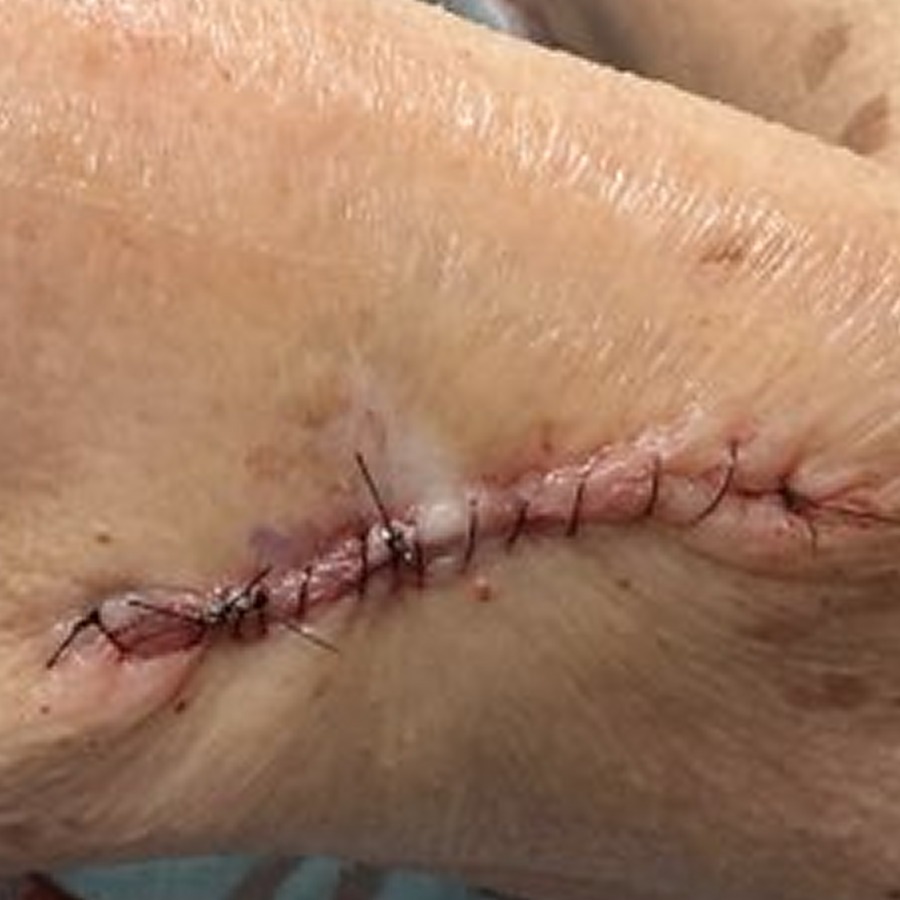 Sutured linear closure on the posterior upper arm