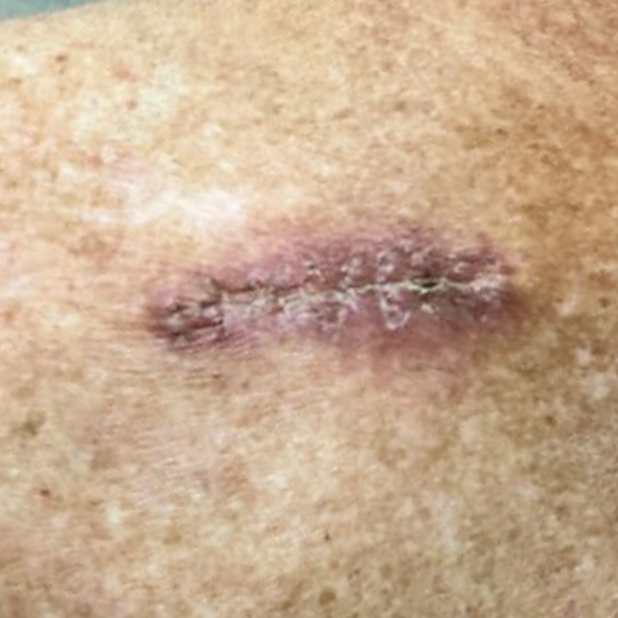 Healed linear scar on the upper back at follow-up
