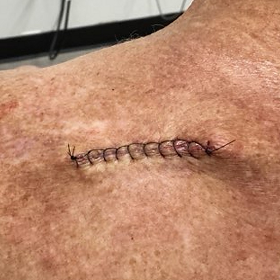 Sutured linear closure on the upper back