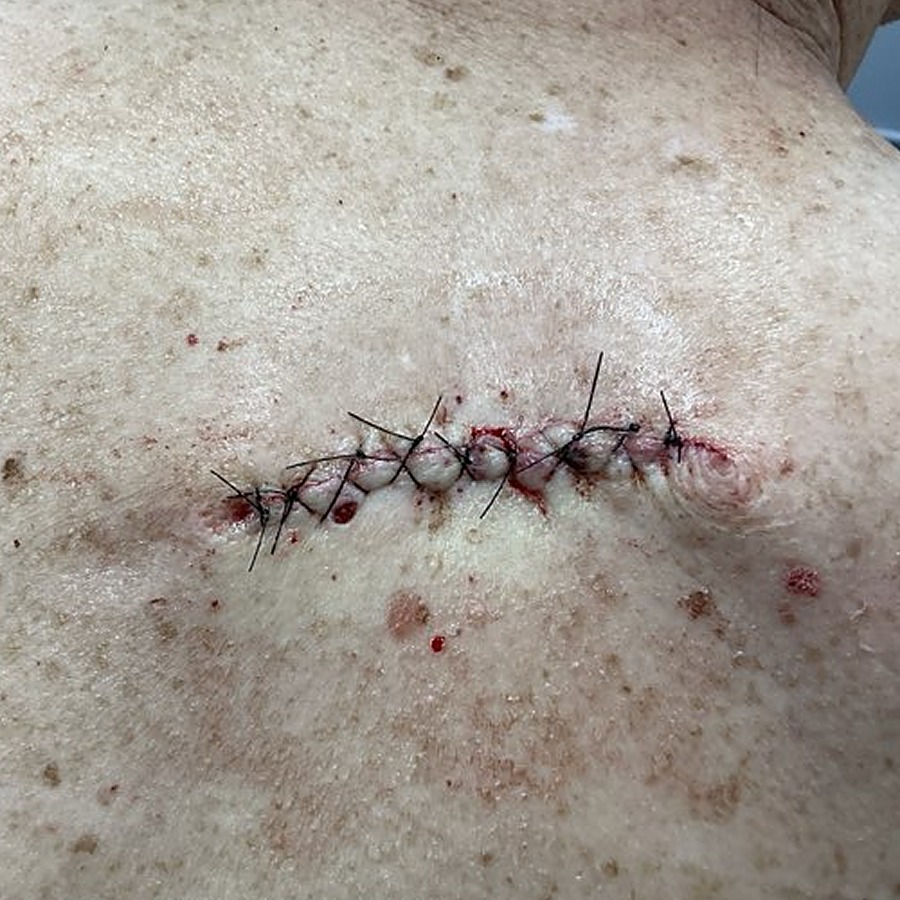 Sutured linear closure on the upper back