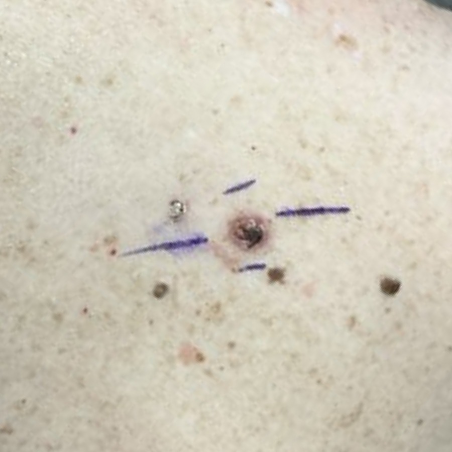 Marked basal cell carcinoma on the upper back before excision