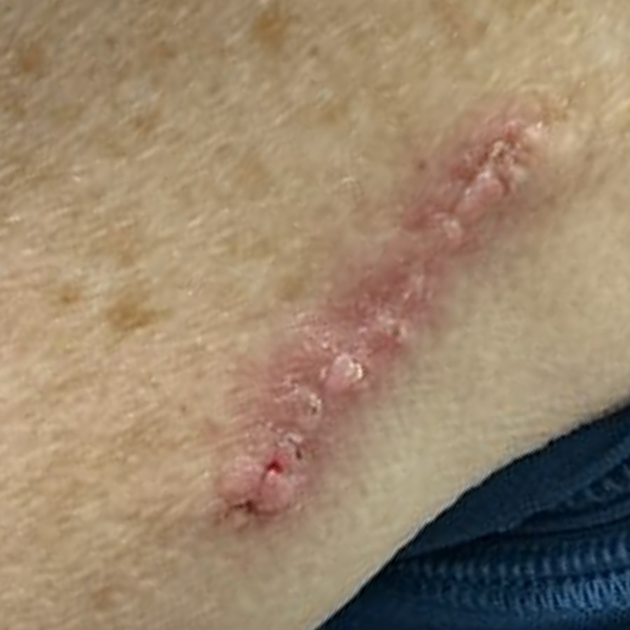 Healed linear scar on the posterior upper arm at follow-up