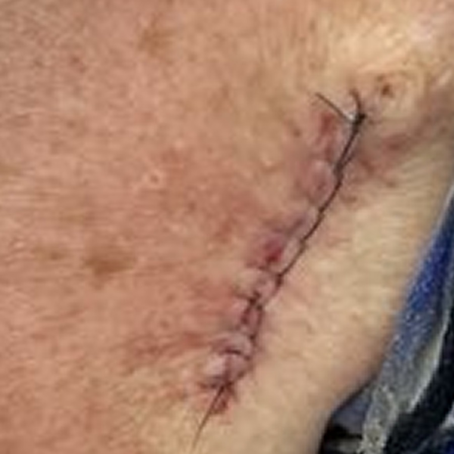 Sutured linear closure on the posterior upper arm