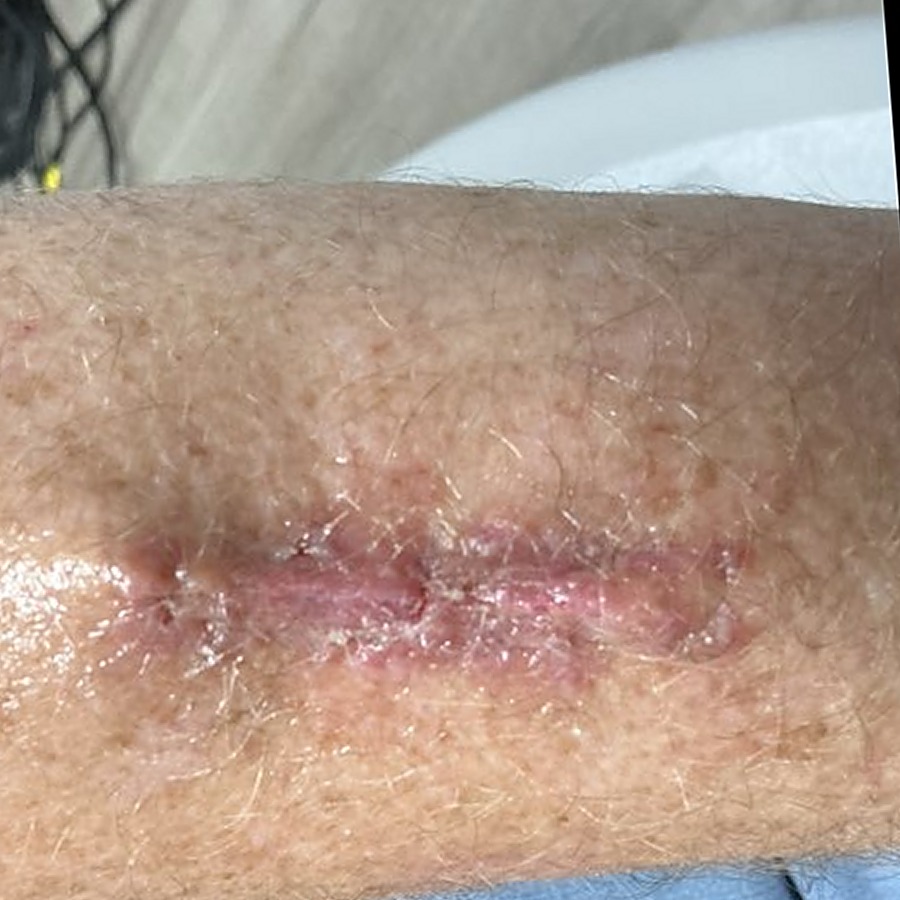 Healed linear scar on the dorsal forearm at follow-up