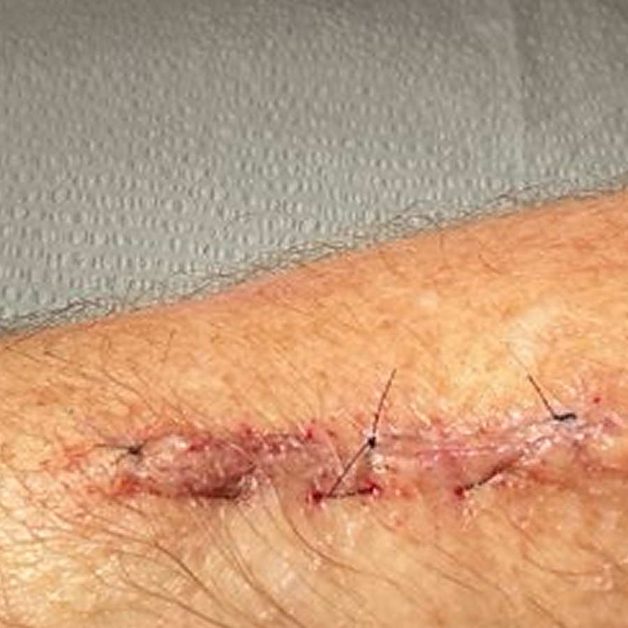 Running horizontal mattress closure on the dorsal forearm